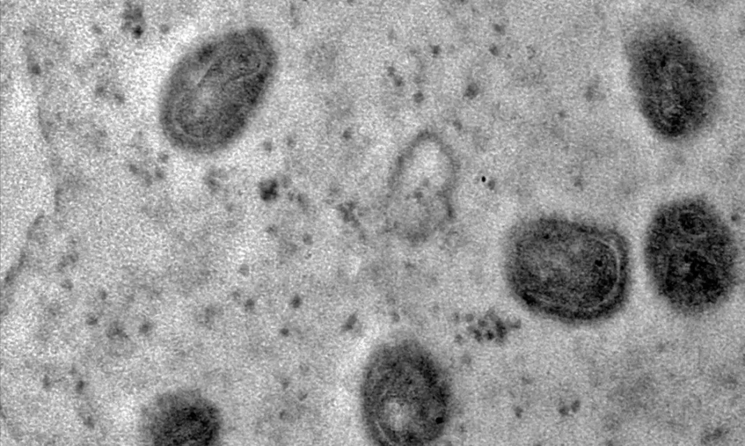 monkeypox_03